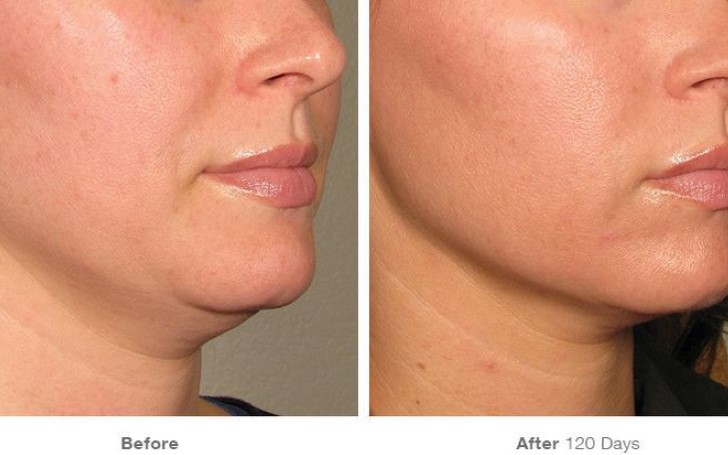 Everything You Need to Know About Laser Skin Tightening - Can It Give You A More Chiseled Jaw Line?