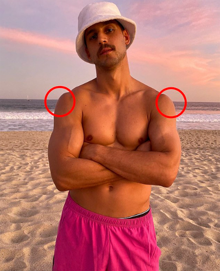 Michael Brunelli in a shirtless photo on the beach with two highlighting red circles to show his shoulder. 