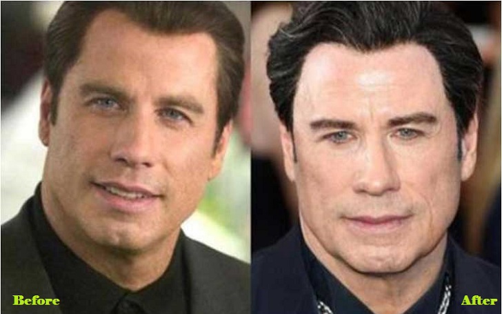 American singer and actor John Travolta Went Under The Knife; Before and After Pictures