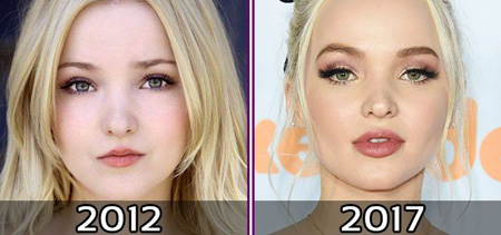 The lips of Dove Cameron appear fuller than they did before.