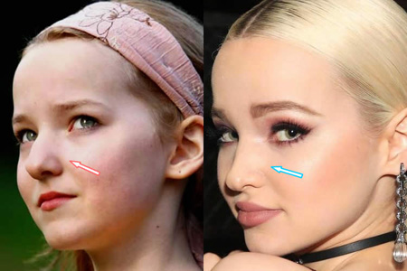 Dove Cameron seemingly got her nose fixed a little.