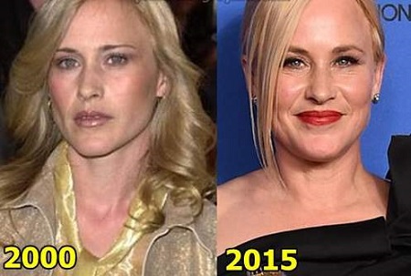 Before and After photos for Patricia Arquette Plastic Surgery rumors.