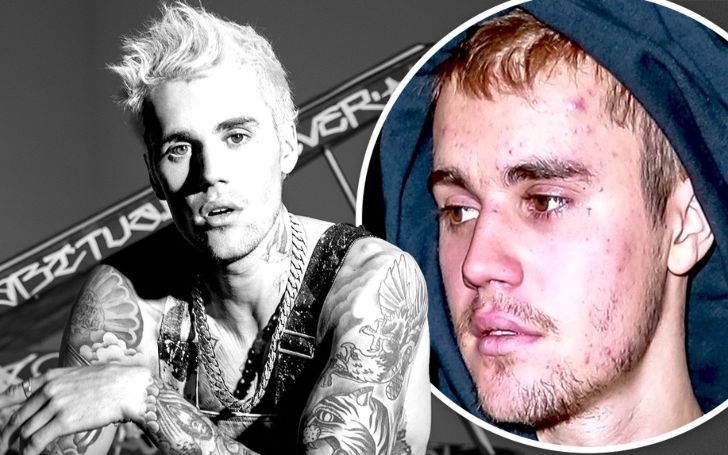 Justin bieber Speaks About His Incurable Lyme Disease & Its Serious Impacts