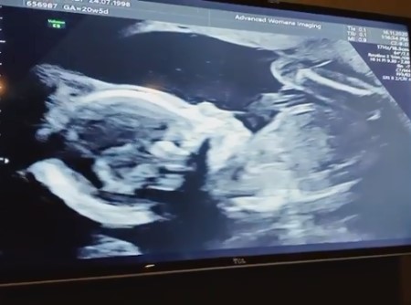 bindi irwin ultrasound video.