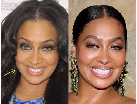 La La Anthony Plastic Surgery.