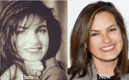 Mariska Hargitay Plastic Surgery.