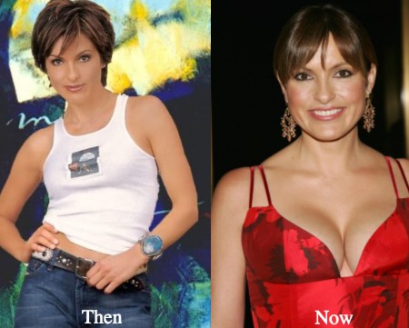 Mariska Hargitay Plastic Surgery.