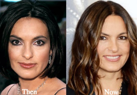 Mariska Hargitay Plastic Surgery.