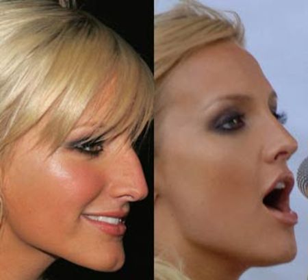 Before and after nose job pictures of Ashlee Simpson.