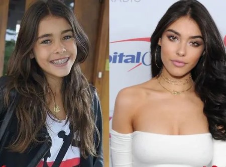 Madison Beer Plastic Surgery.