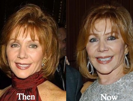 joy philbin plastic surgery.