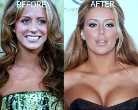 Aubrey ODay Plastic Surgery