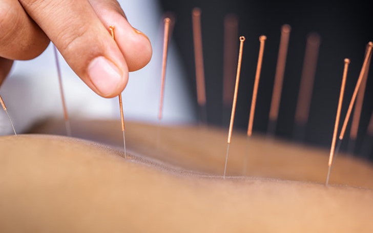 Why Acupuncture Can Lead To A Healthier And More Beautiful You