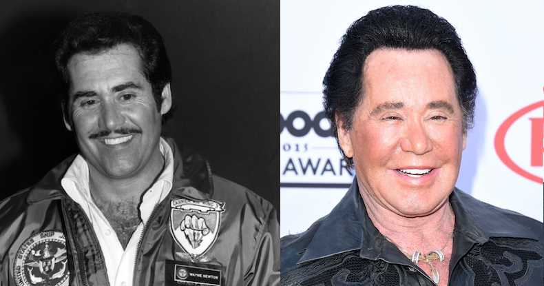 Wayne Newton's Bad Plastic Surgery: All Details